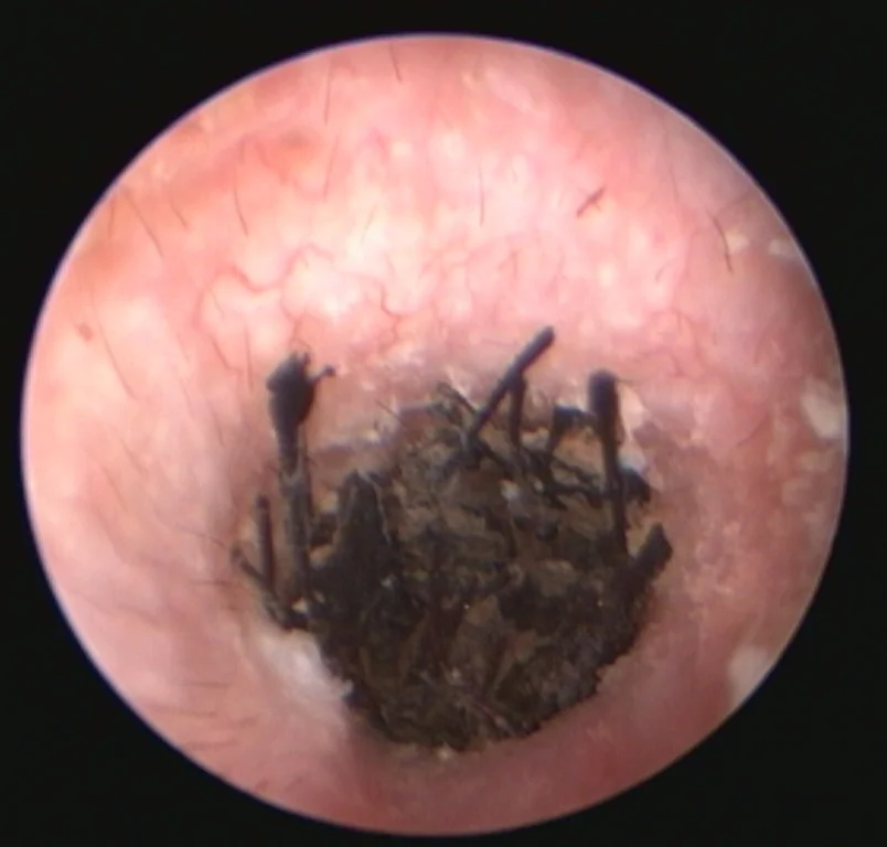 Video-otoscope view of a dog’s ear canal blocked by dark discharge and hair, with a reddened wall