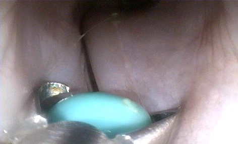 Endoscopy image: forceps holding the turquoise head of a needle, with the thin shaft of the needle visible behind it